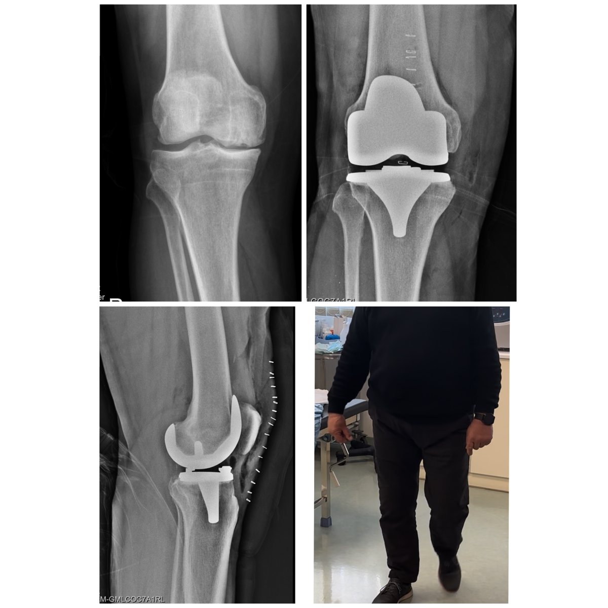 نتائج قبل وبعد استبدال مفصل الركبة في عيادة Dr Andreas Papadopoulos