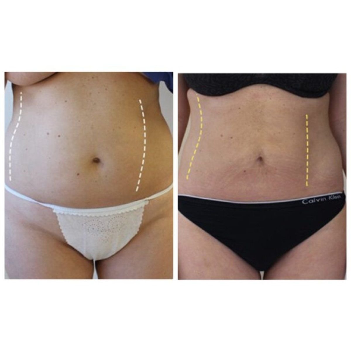 Avant et après liposuccion à Klinika La Perla, amélioration visible du contour de la taille