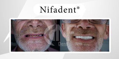 All-on-4 Implants for Permanent Smile Restoration - photo 5