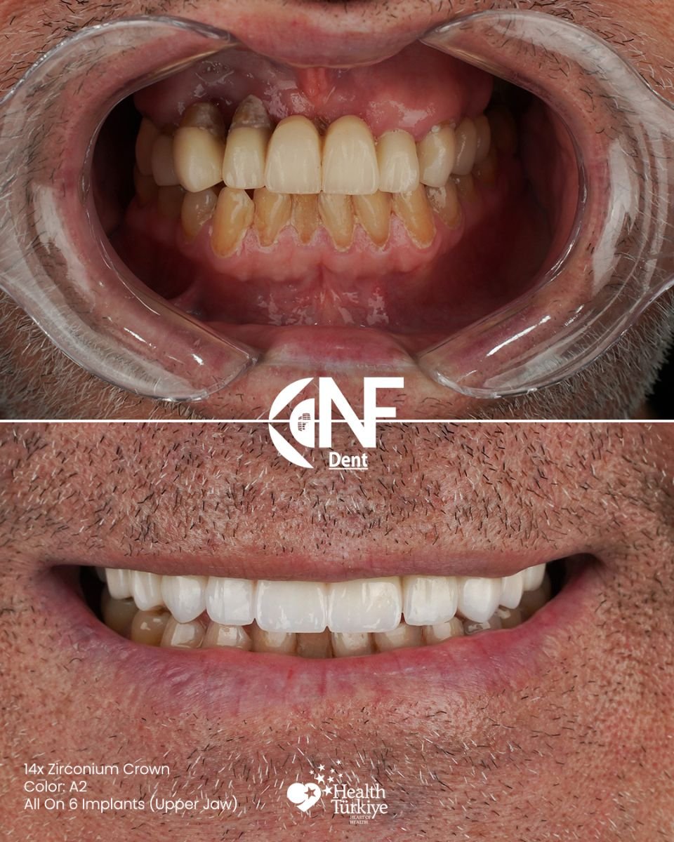 Efekt przed i po implantach All-on-6 w Nifa Dent International, odbudowa uśmiechu