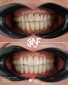 All-on-4 Implants for Permanent Smile Restoration - photo 6