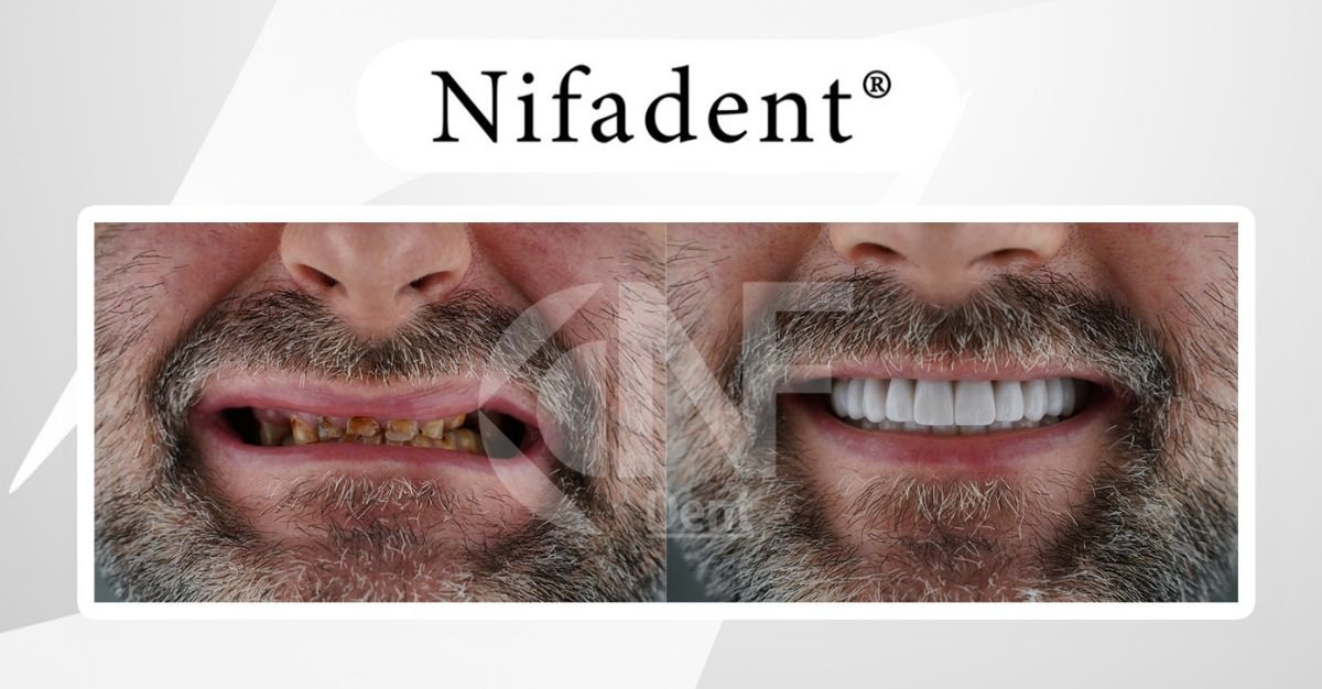 Before and after All-on-4 dental implants result at Nifa Dent International, smile restoration