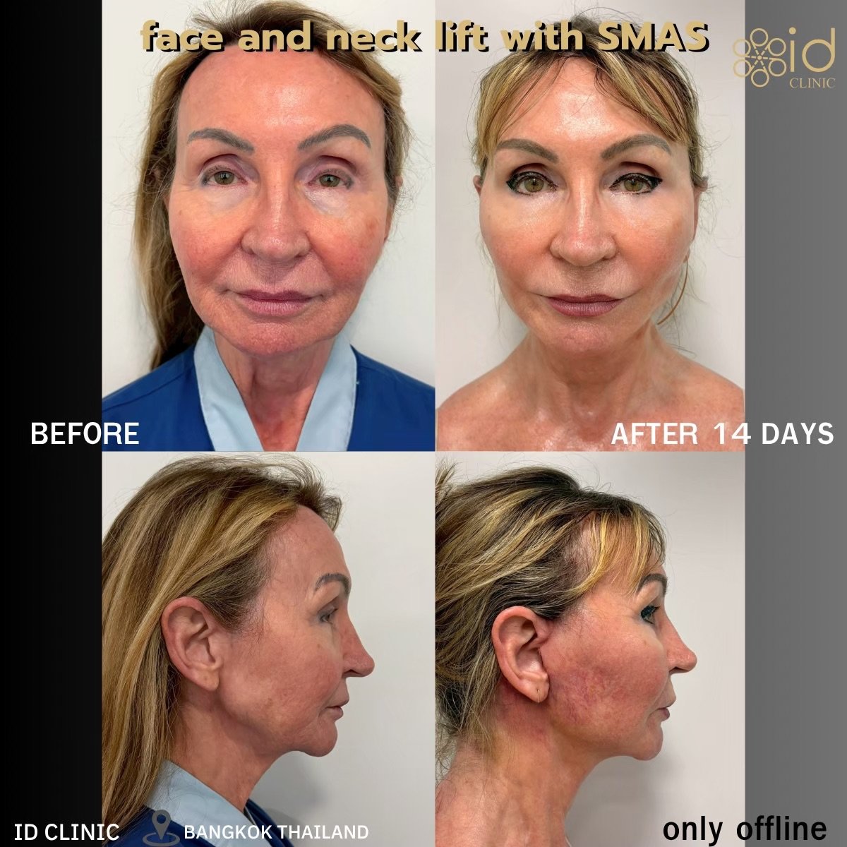 Face and neck lift with SMAS before and after results at ID Clinic Bangkok, 14 days post-op
