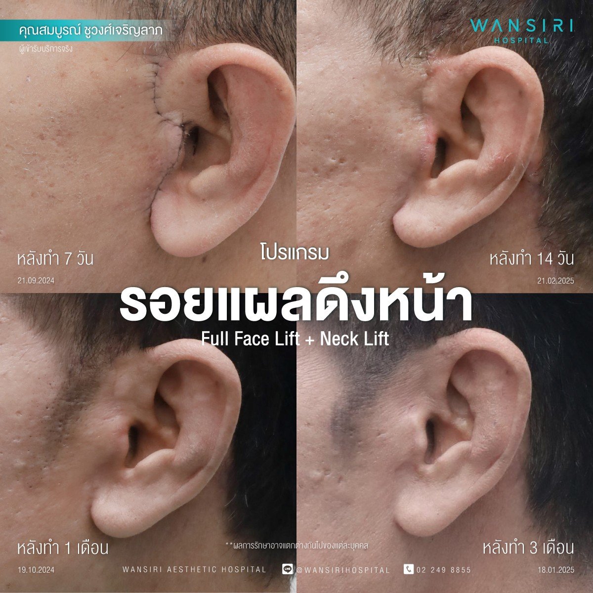 Resultados de cicatrización tras lifting facial y de cuello en Wansiri Hospital, fotos antes y después