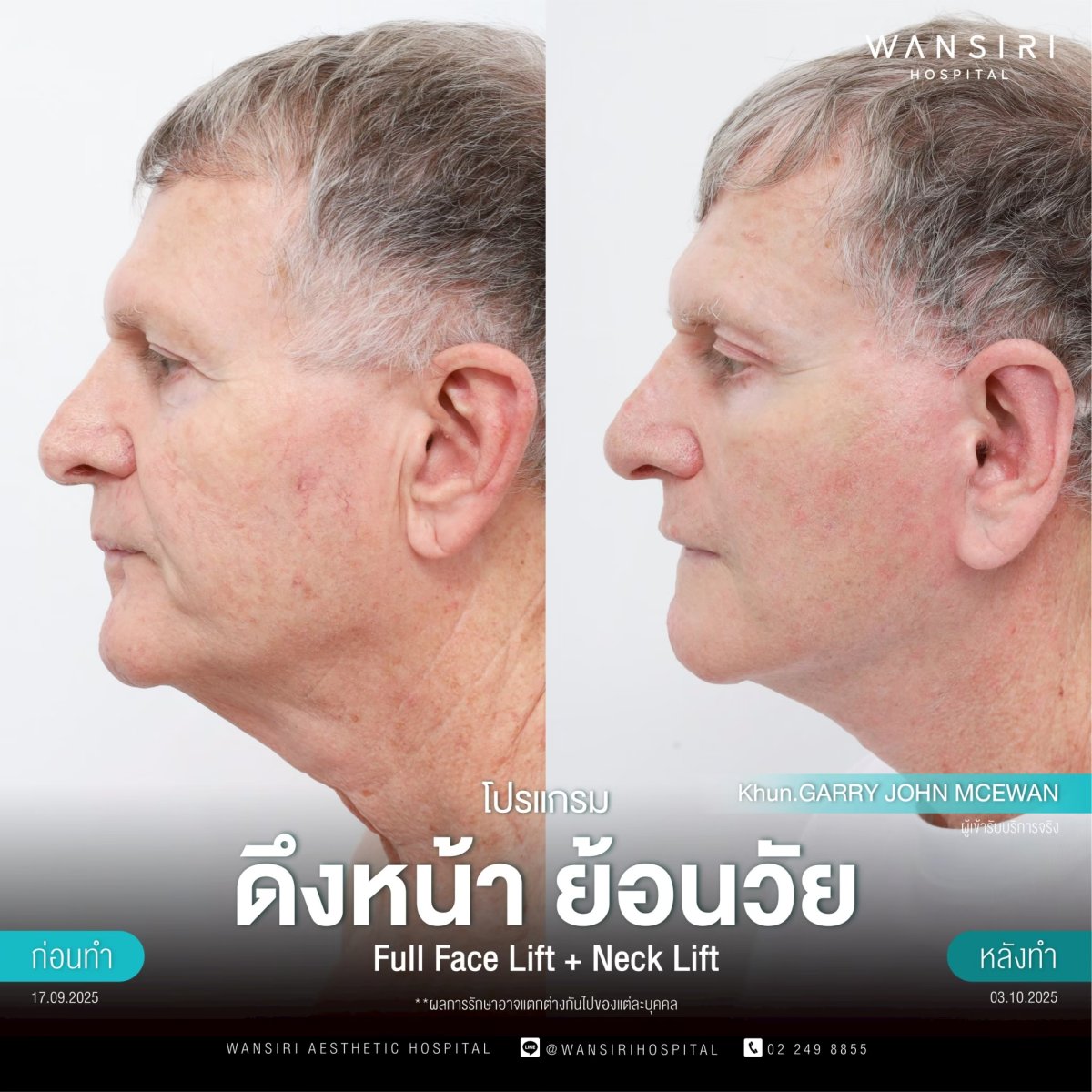 Результаты до и после deep plane фейслифтинга и подтяжки шеи в Wansiri Hospital
