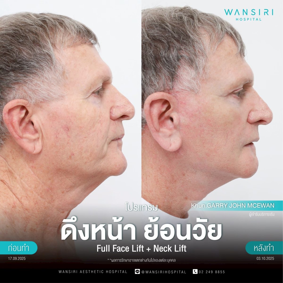 Результаты до и после deep plane SMAS лифтинга и подтяжки шеи в Wansiri Hospital