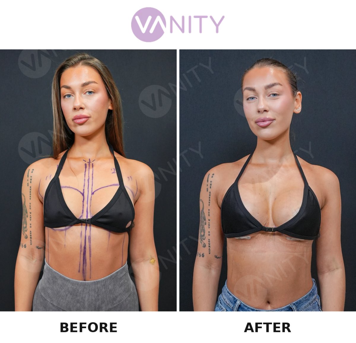 Resultados antes y después de implantes y levantamiento de senos en VANITY COSMETIC SURGERY HOSPITAL