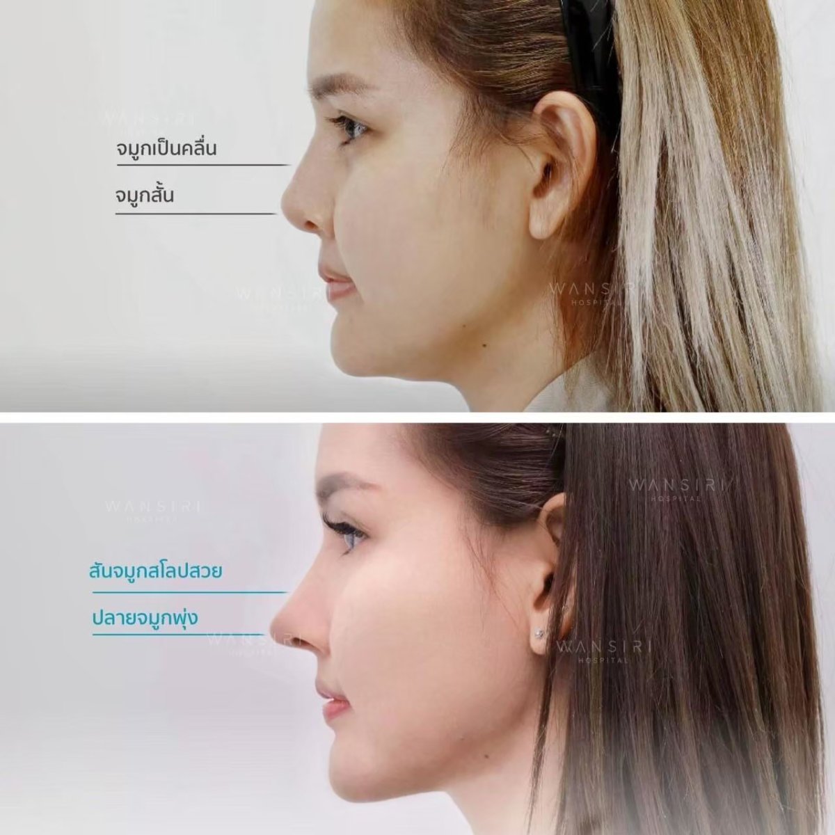 Vorher-nachher-Rhinoplastik bei Wansiri Hospital, natürliche Nasenprofil-Ergebnisse