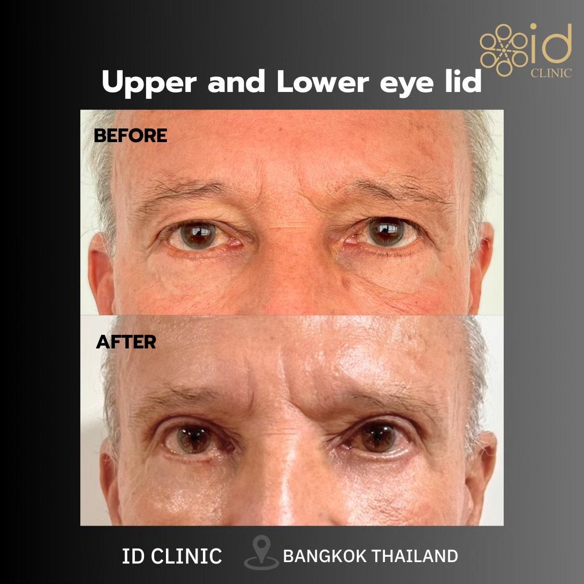 Before and after upper and lower eyelid surgery results at ID Clinic Bangkok
