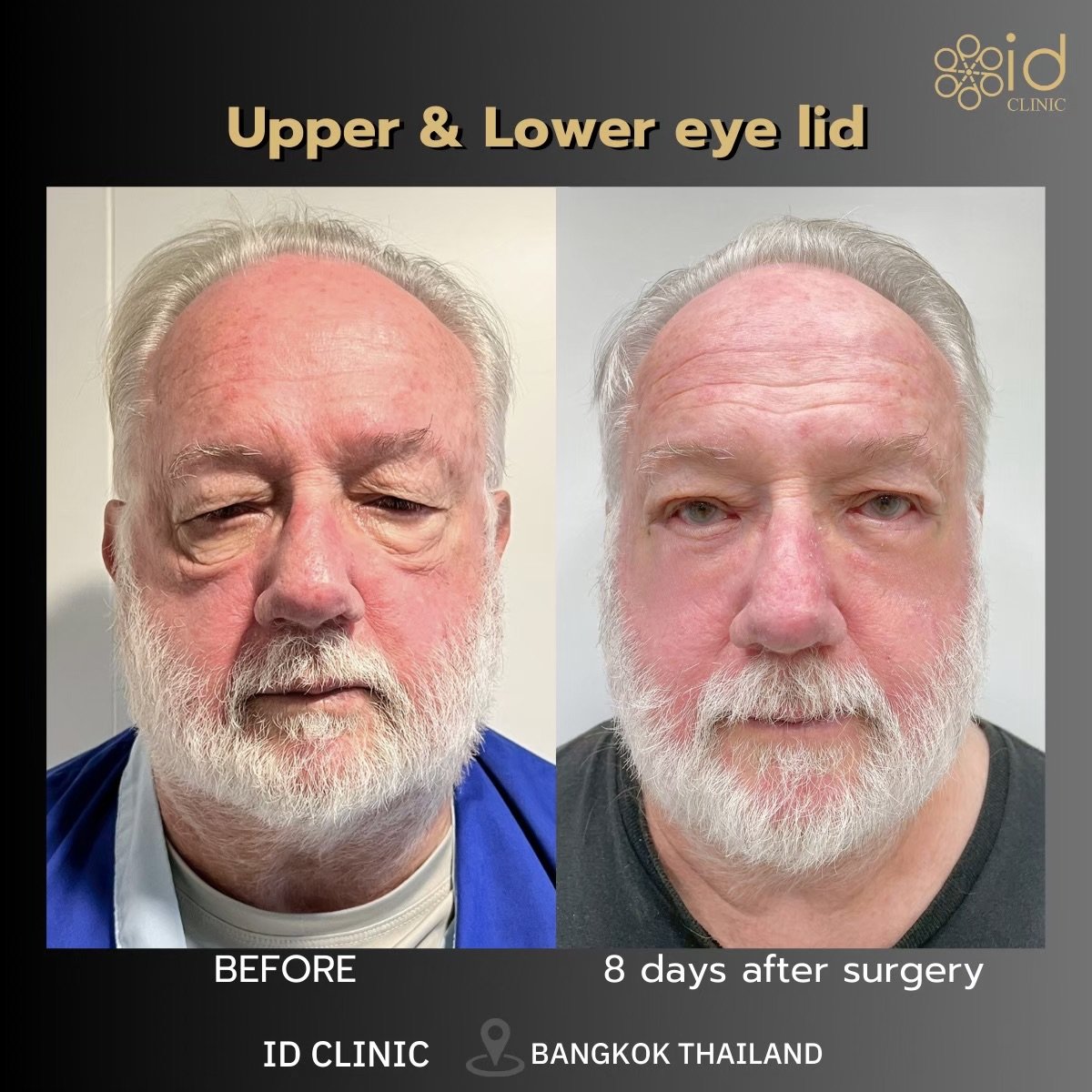 Before and after upper and lower eyelid surgery results at ID Clinic Bangkok