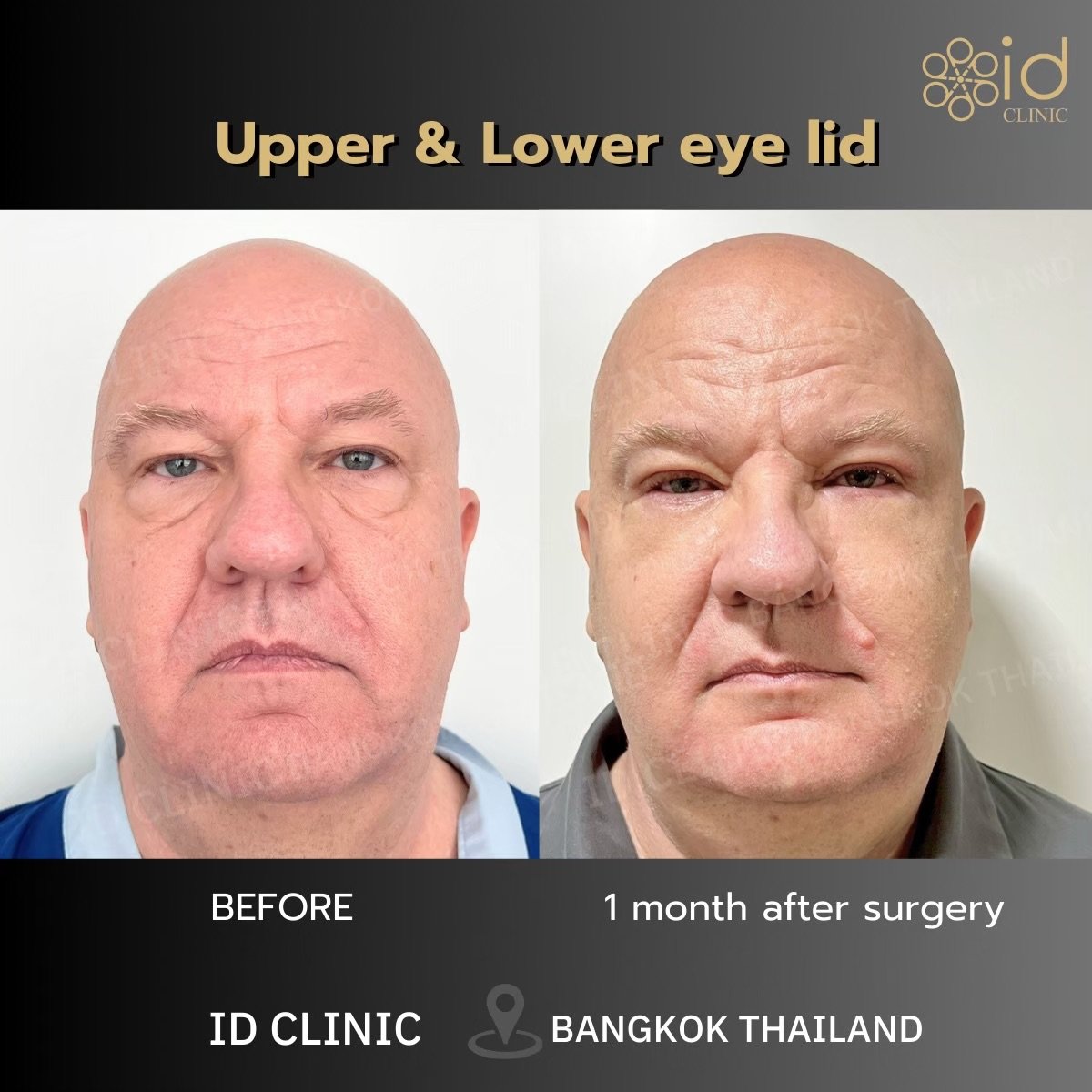 Before and after upper and lower eyelid surgery results at ID Clinic Bangkok