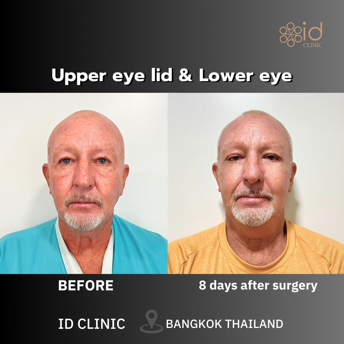 Before and after upper and lower eyelid surgery results at ID Clinic Bangkok, 8 days post-op
