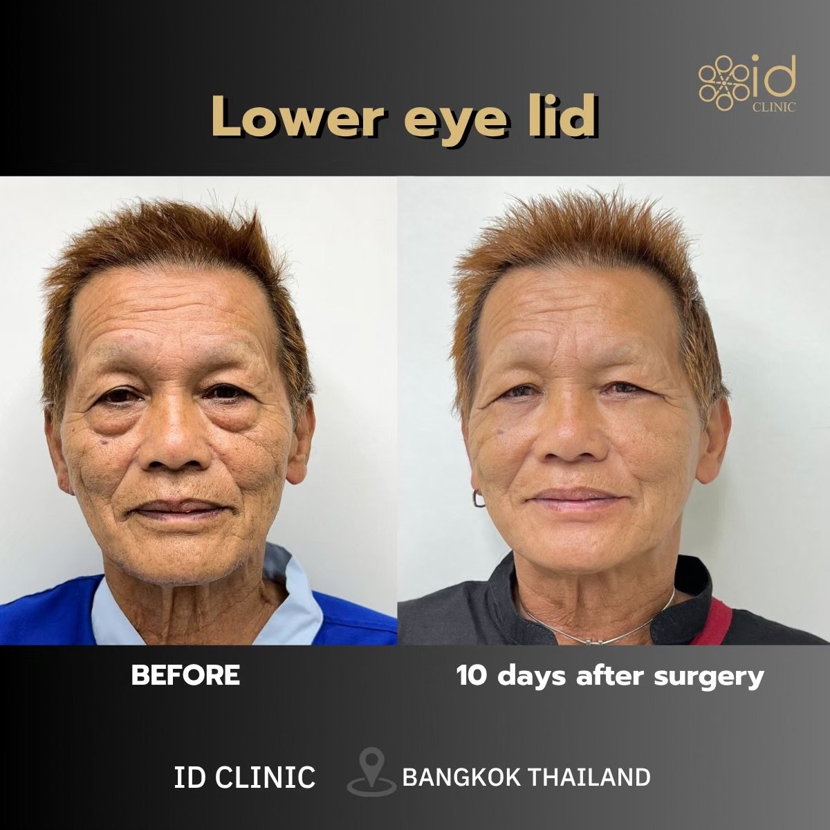 Lower eyelid surgery before and after results at ID Clinic Bangkok, visible eye area improvement