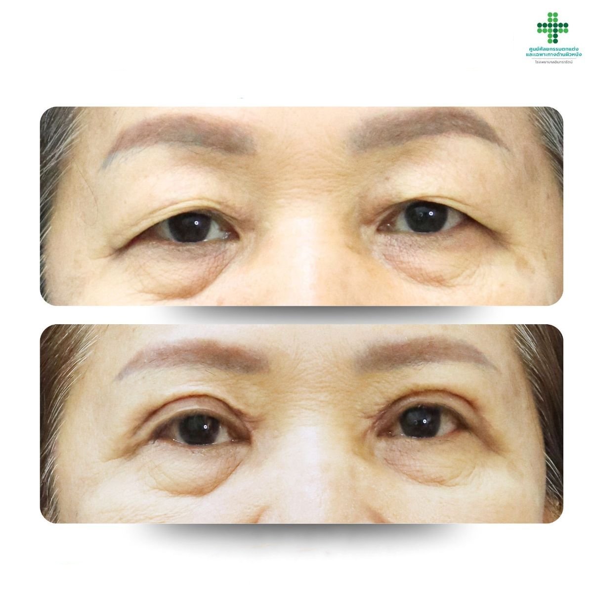 Before and after blepharoplasty results at Intrarat Hospital, eyelid correction improvement