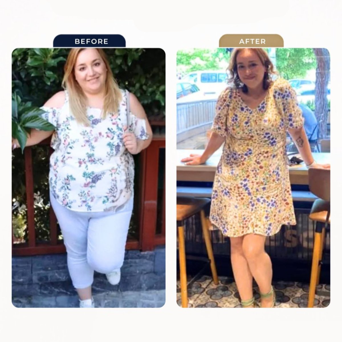 Résultats avant et après sleeve gastrectomie à Estexper Clinic – perte de poids visible
