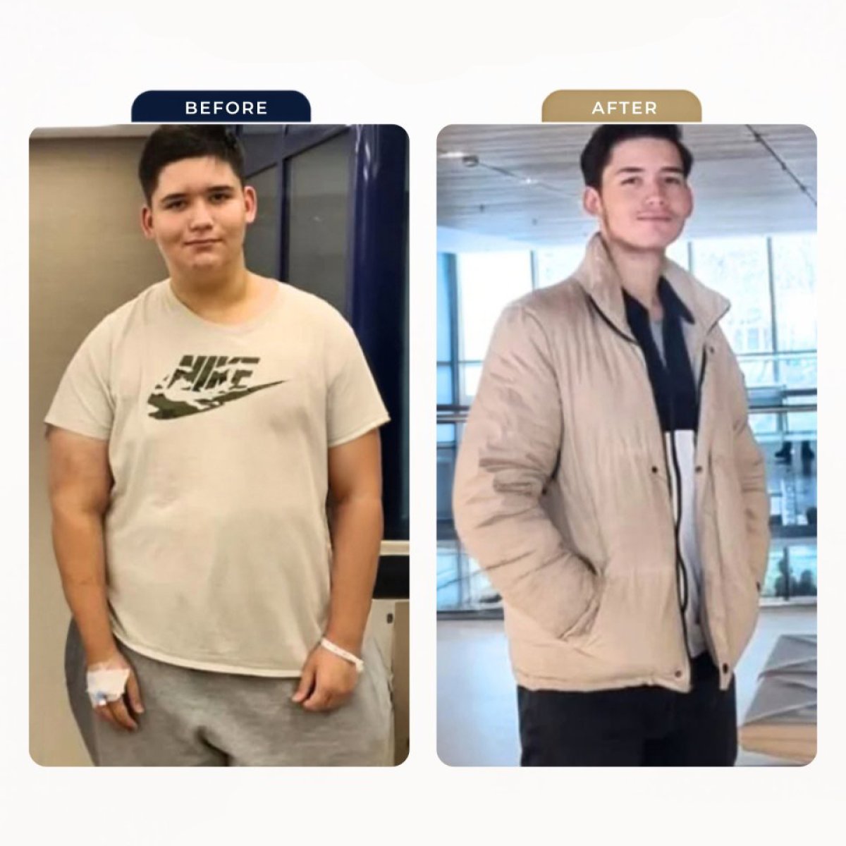 Resultados antes y después de manga gástrica en Estexper Clinic – pérdida de peso visible