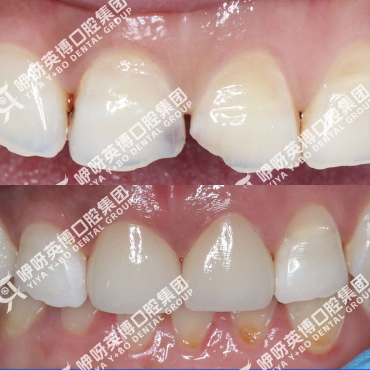 До та після встановлення вініров у Shanghai Y+bo Dental Clinic – результат відновлення усмішки