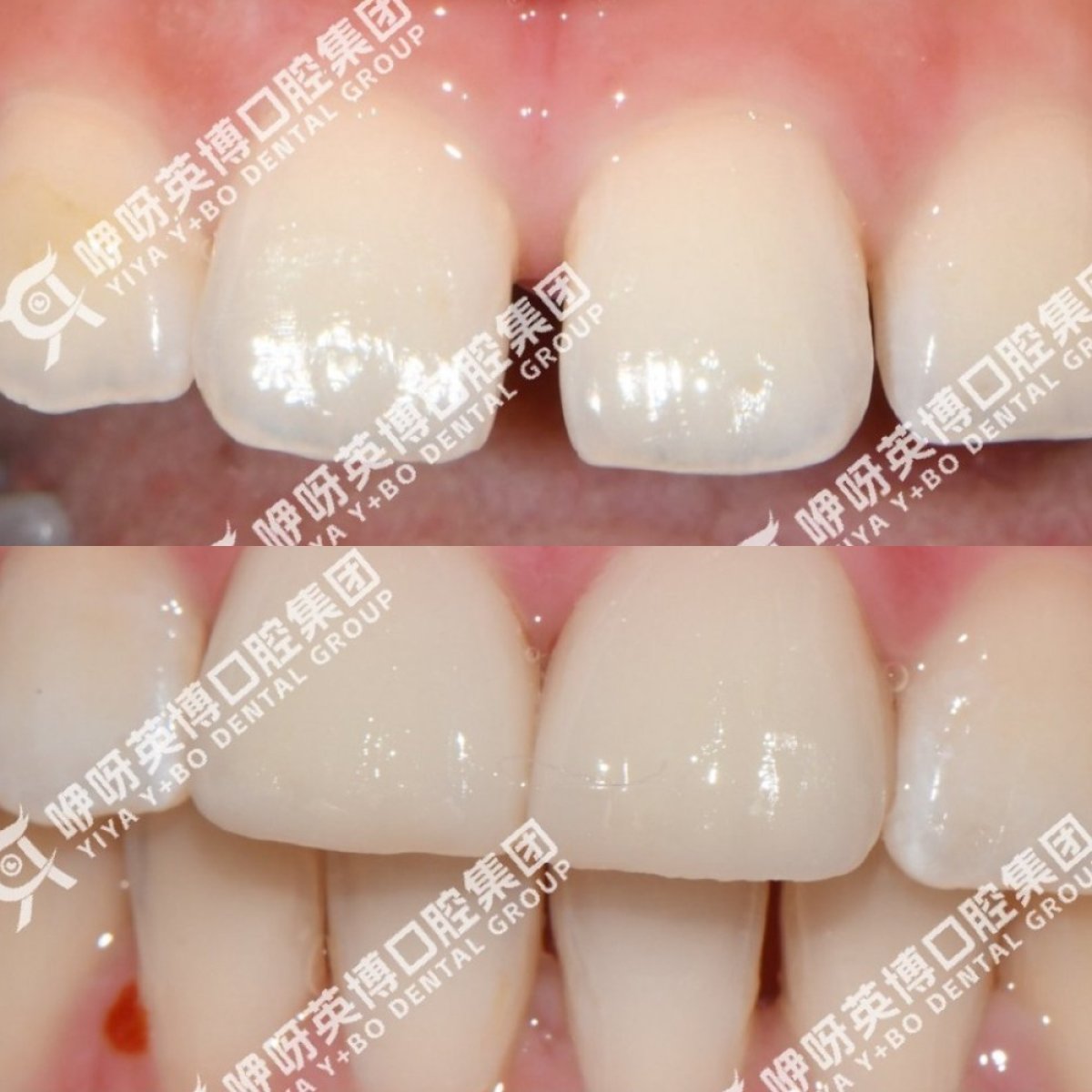 نتيجة قبل وبعد الفينير في عيادة Shanghai Y+bo Dental Clinic، تحسين مظهر الابتسامة