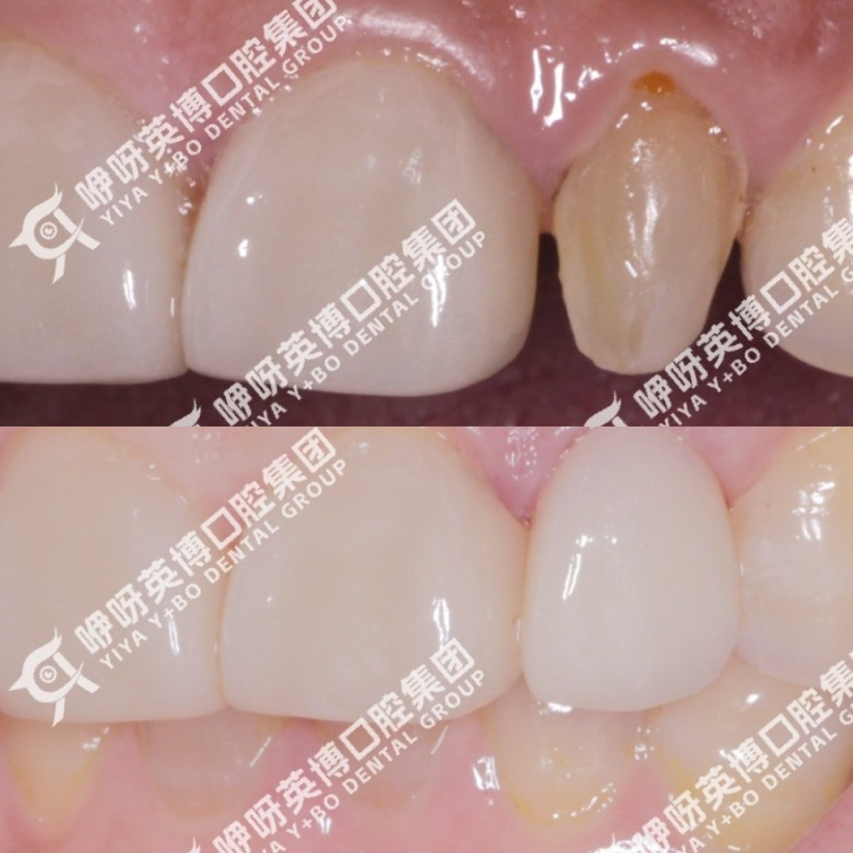 نتيجة قبل وبعد الفينير في عيادة Shanghai Y+bo Dental Clinic، تحسين مظهر الأسنان الأمامية