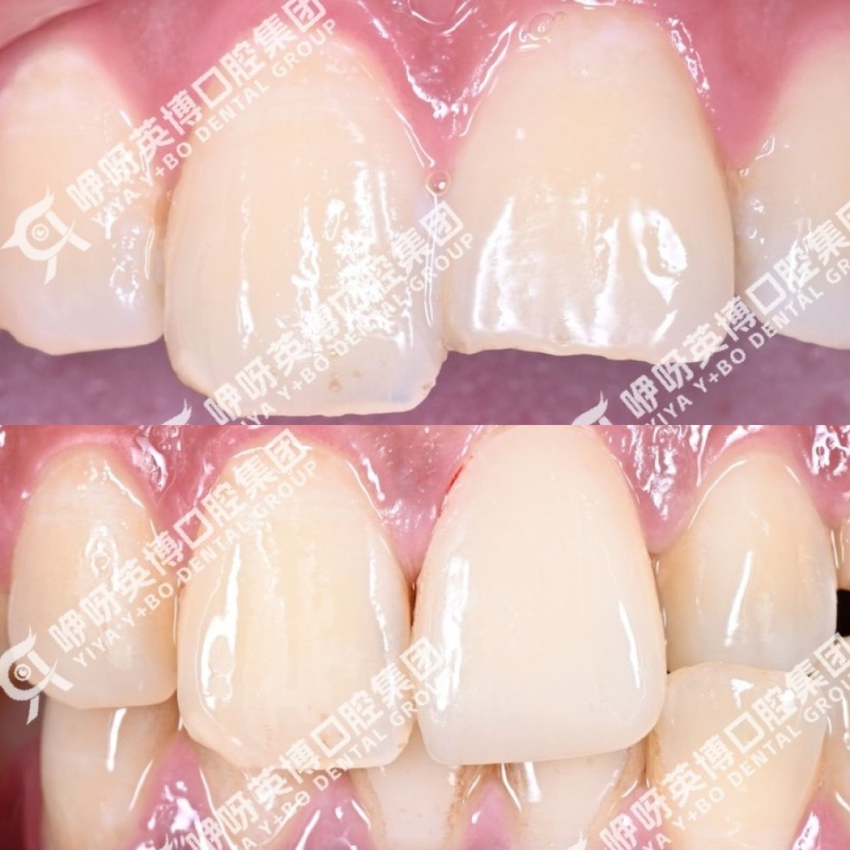 Before and after dental veneers result at Shanghai Y+bo Dental Clinic for smile restoration