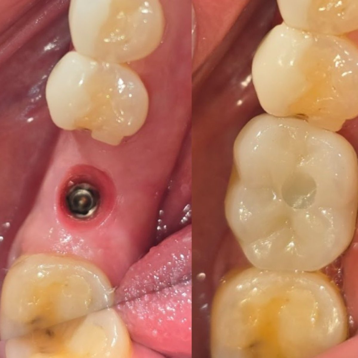 Efekty przed i po implantacji zęba – odbudowany ząb trzonowy o naturalnym wyglądzie
