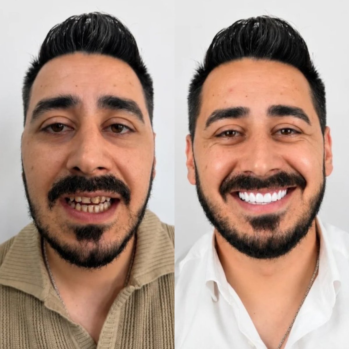نتائج قبل وبعد إجراء الفينيرز – ابتسامة متحولة بأسنان بيضاء ومتساوية