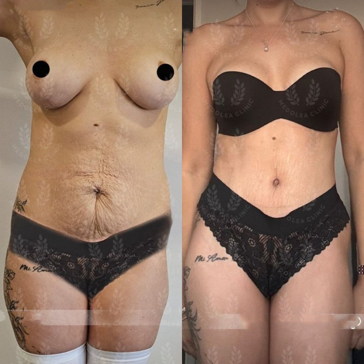 نتائج شفط الدهون 360 قبل وبعد في عيادة Dr. Safa Manav، تحسين شكل الجسم