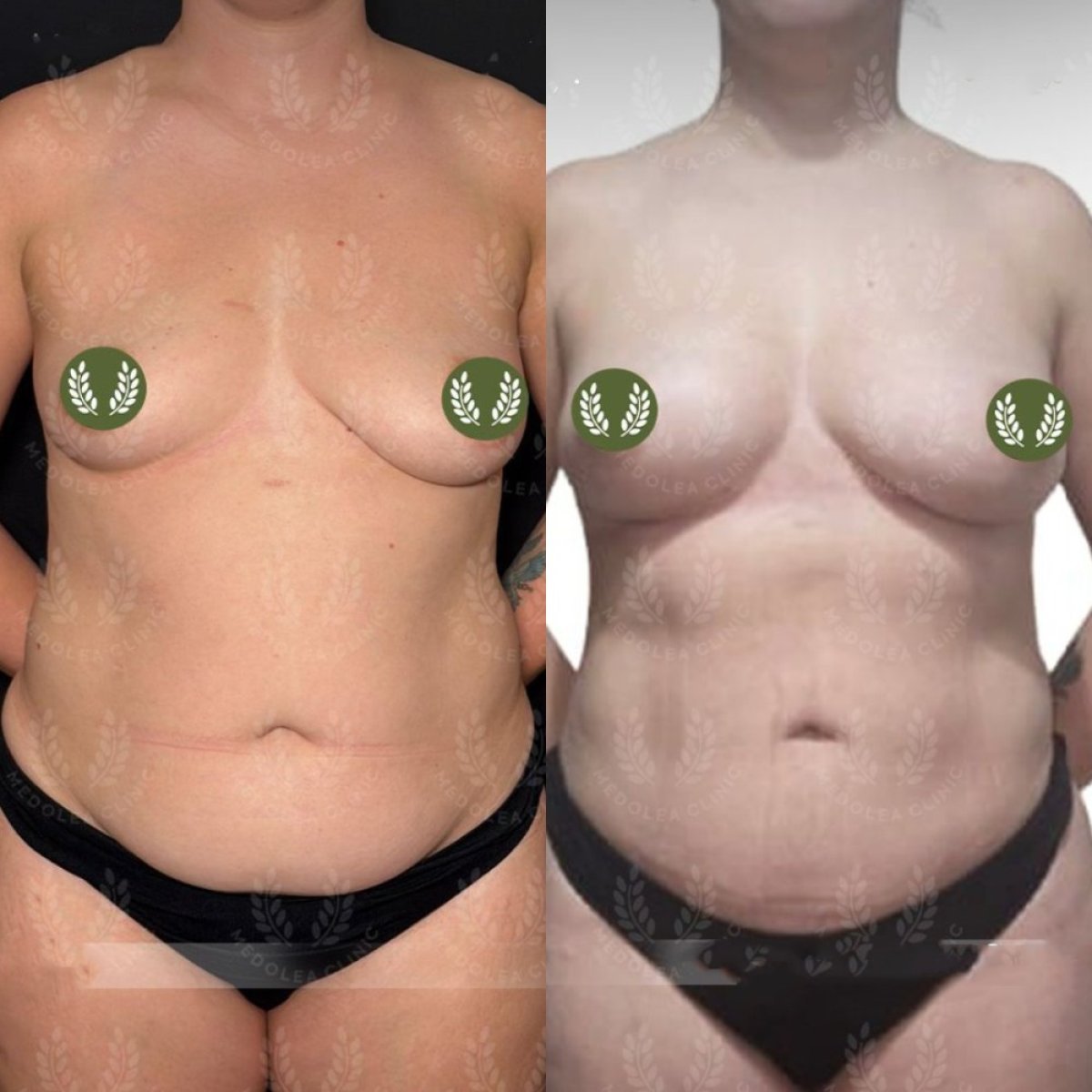 Resultados de liposucción antes y después en Dr. Safa Manav Clinic, mejora visible del contorno corporal