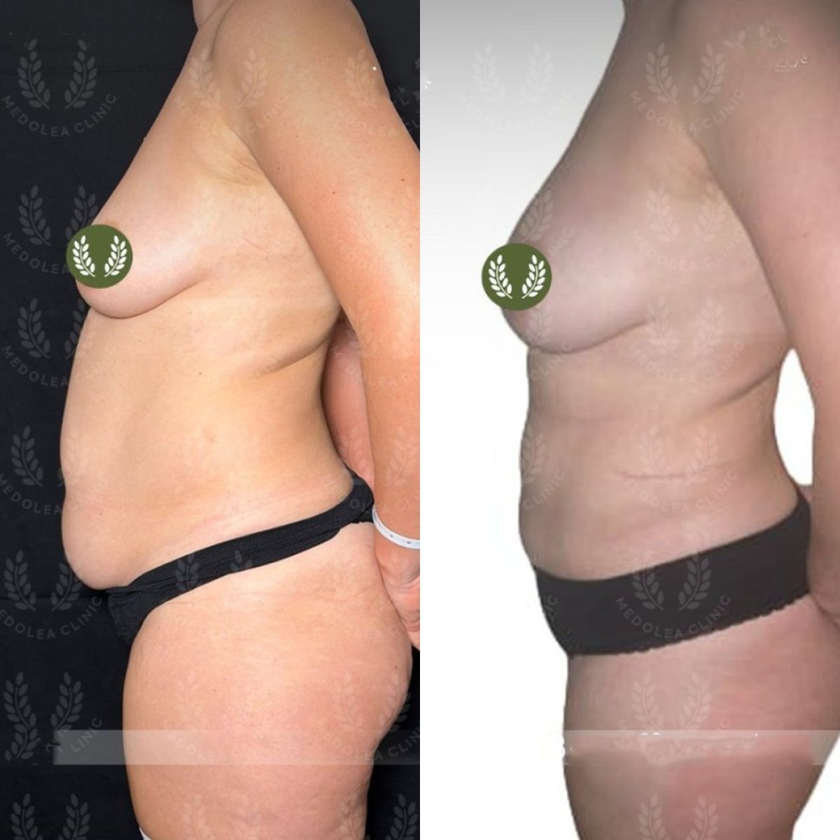 Resultados de liposucción antes y después en Dr. Safa Manav Clinic, mejora visible del contorno corporal