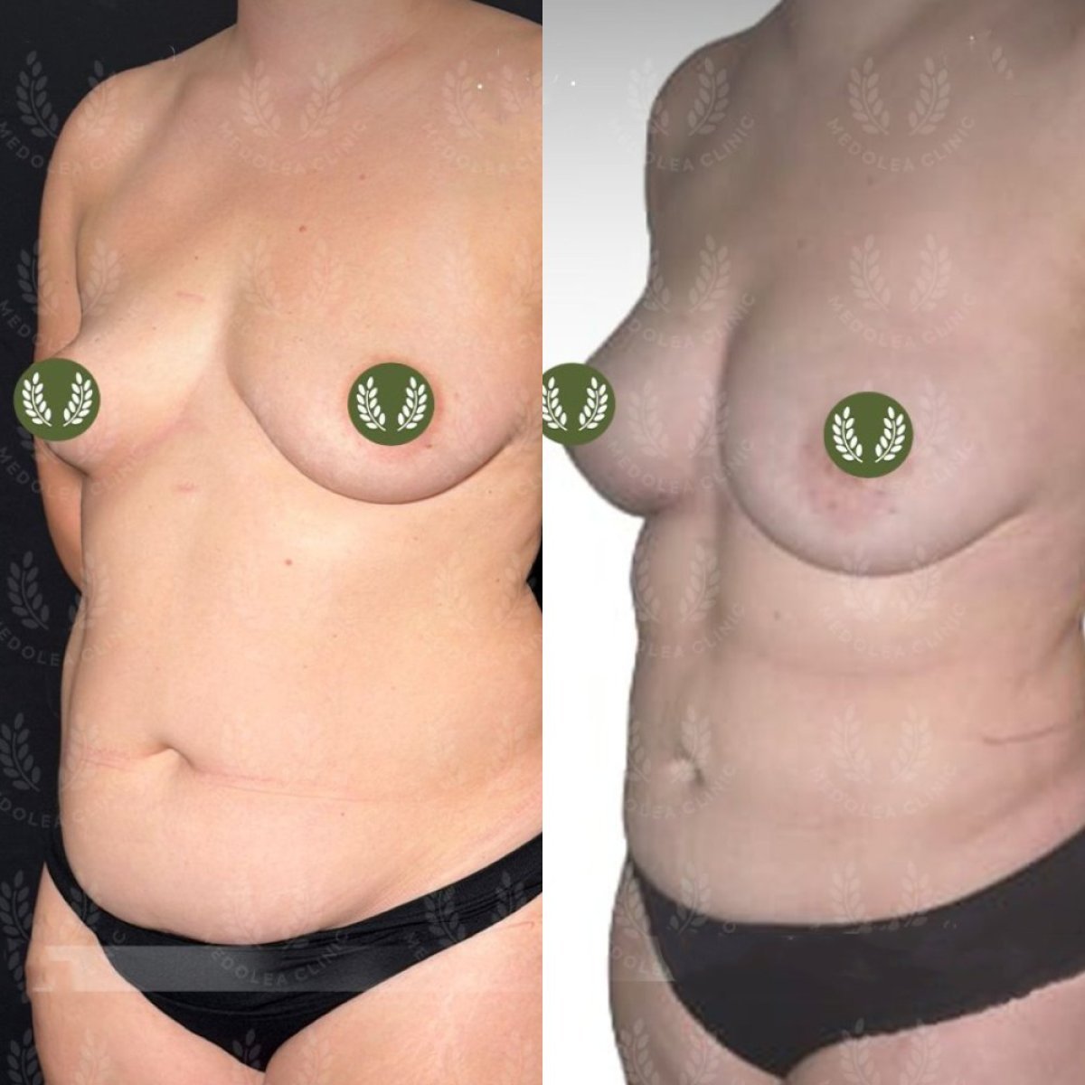 Resultados de liposucción antes y después en Dr. Safa Manav Clinic, mejora visible del contorno