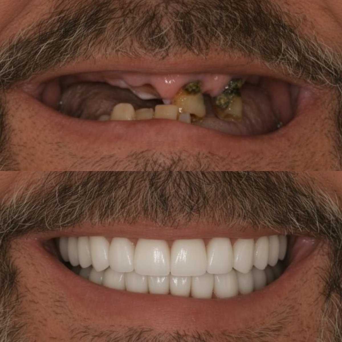 Before and after dental implant results at CIVICO DENTAL CARE MEXICALI, restored smile transformation