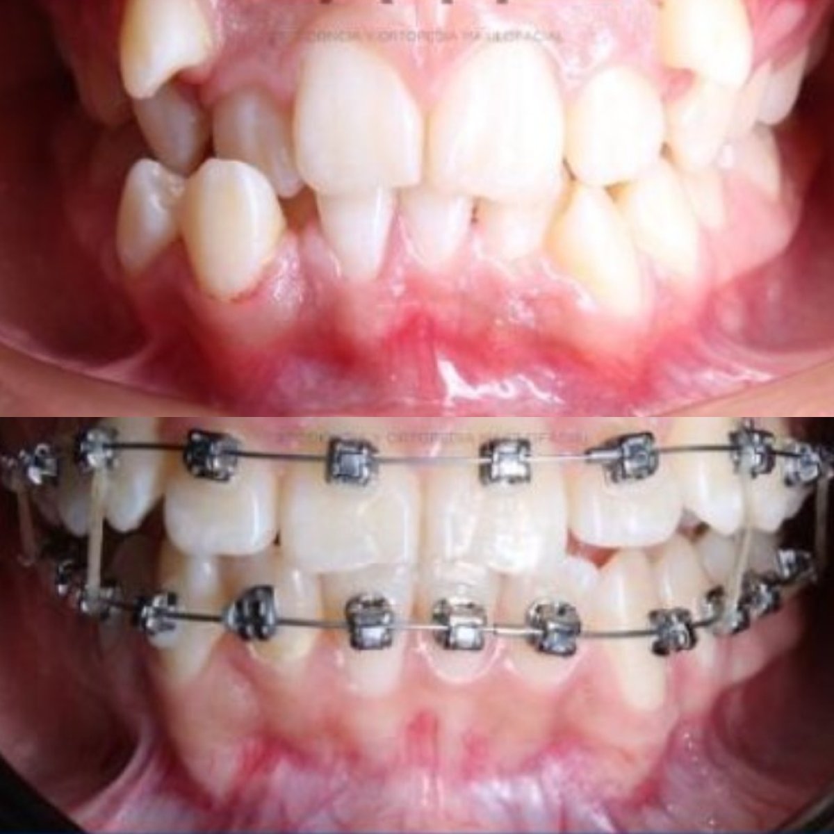 قبل وبعد علاج التقويم في CIVICO DENTAL CARE MEXICALI، نتيجة تصحيح الأسنان
