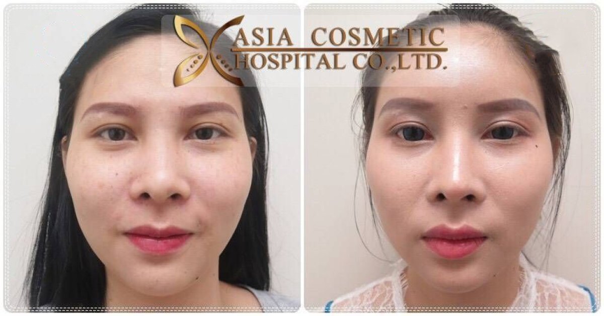 Before and after forehead augmentation result at Asia Cosmetic Hospital, enhanced forehead contour