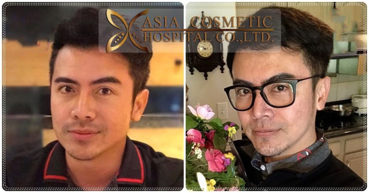 نتائج قبل وبعد زراعة الذقن في Asia Cosmetic Hospital، تحسن واضح في شكل الذقن