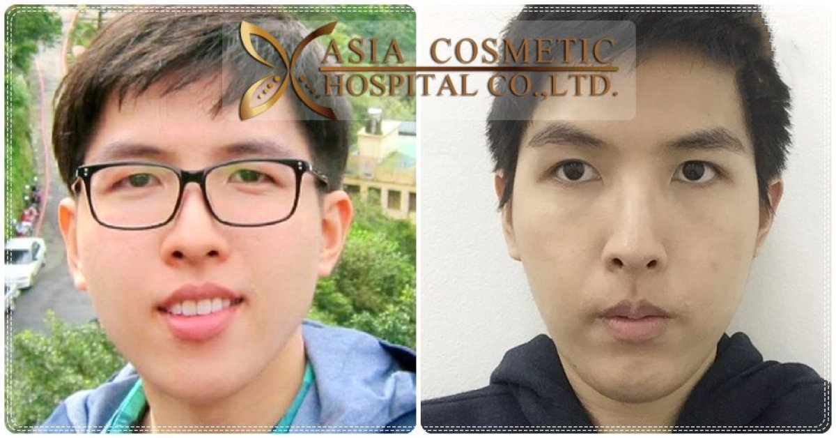 نتائج قبل وبعد زراعة الذقن في Asia Cosmetic Hospital مع تحسين شكل الذقن