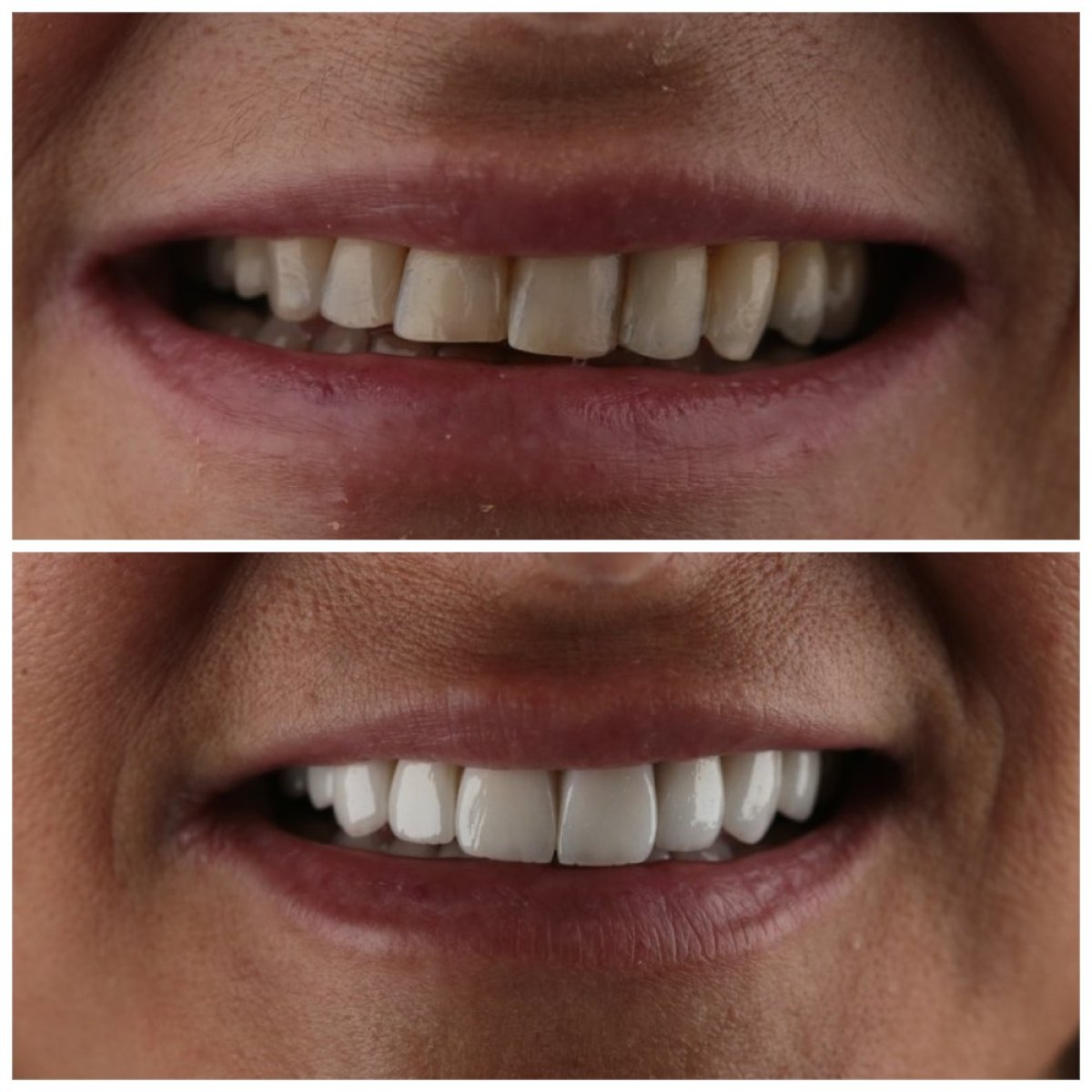 Resultado antes y después de carillas Emax en SUAVE DENTAL CLINIC – transformación de sonrisa