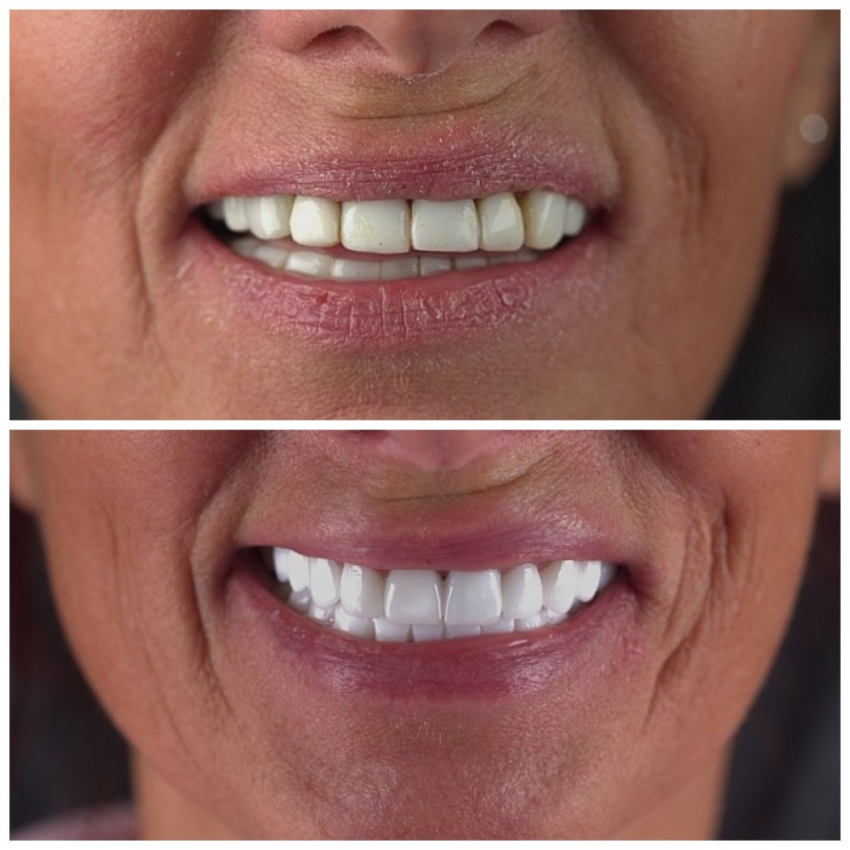 نتائج قبل وبعد تركيب تيجان الأسنان في SUAVE DENTAL CLINIC، تحول الابتسامة