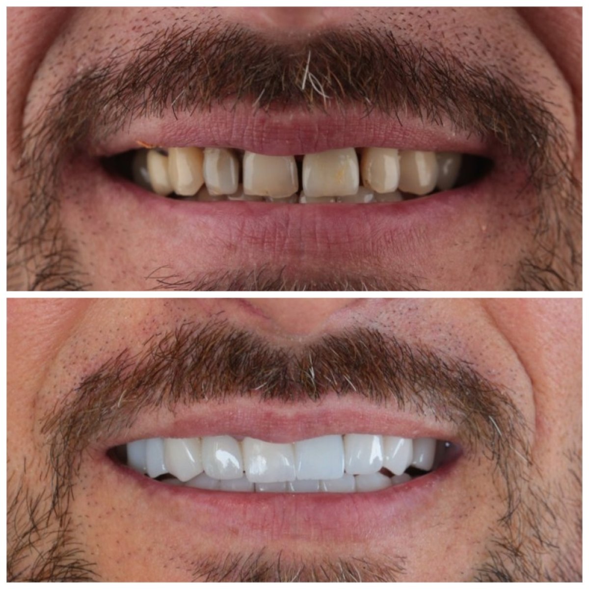 Antes y después de coronas dentales en SUAVE DENTAL CLINIC, resultado de restauración de sonrisa