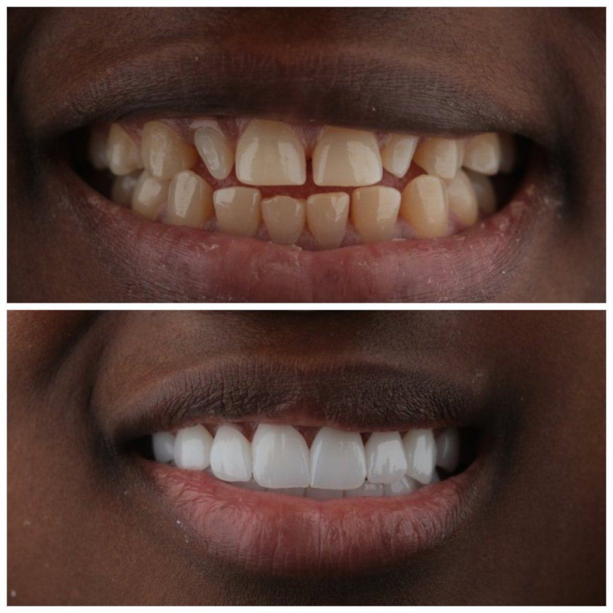 Before and after dental crown installation at SUAVE DENTAL CLINIC, smile makeover results