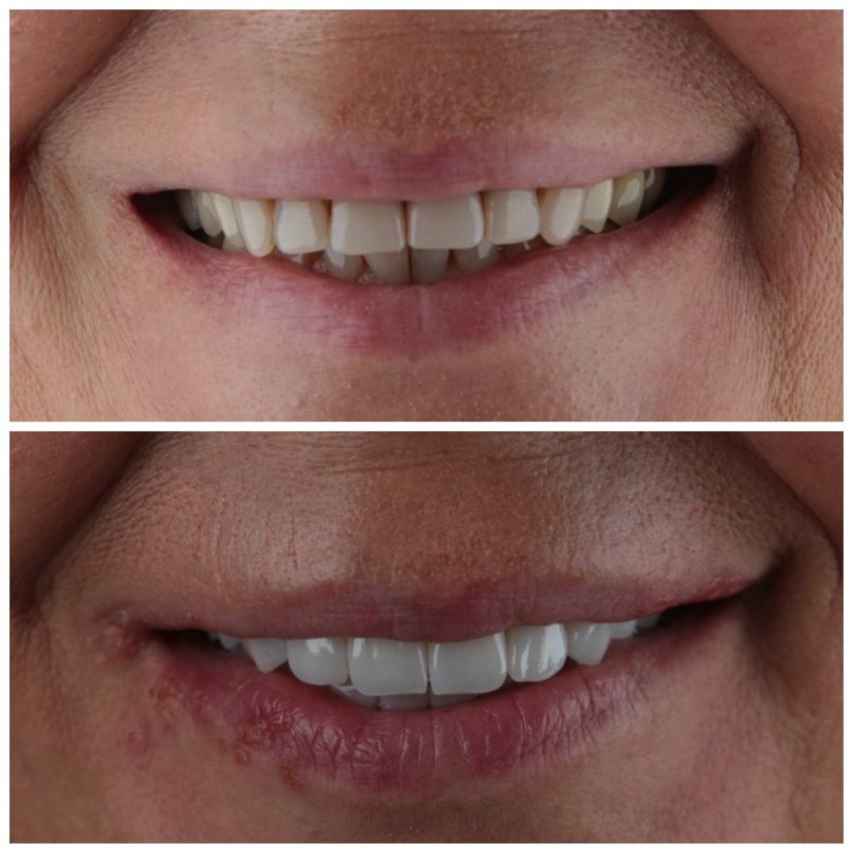 نتائج قبل وبعد تركيب تيجان الأسنان في SUAVE DENTAL CLINIC، ابتسامة محسنة