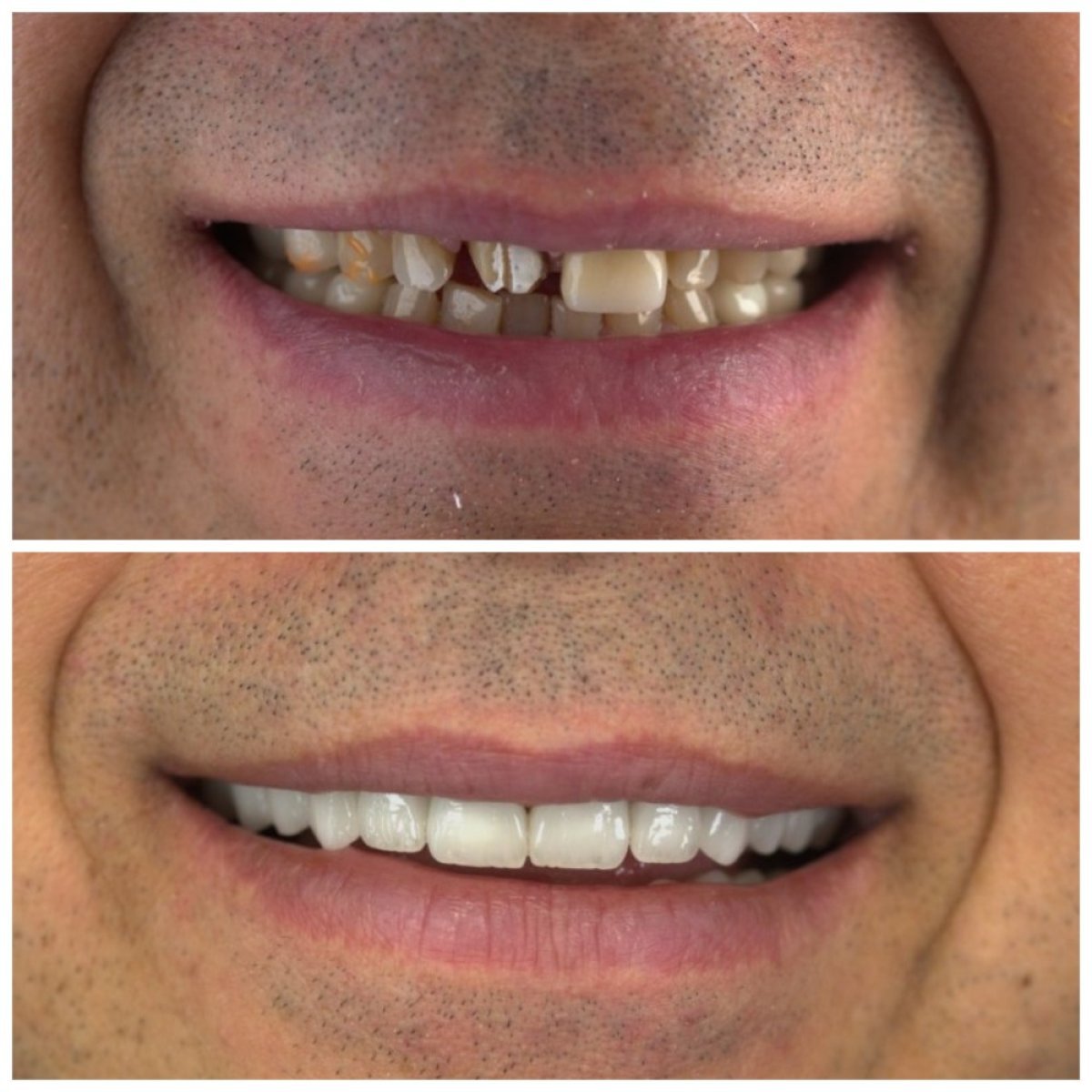 Antes y después de carillas dentales en SUAVE DENTAL CLINIC, sonrisa natural