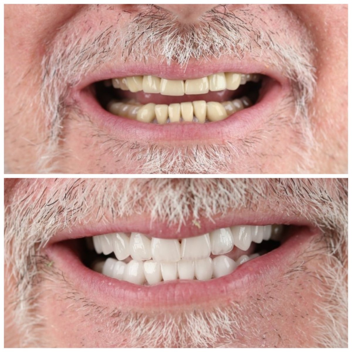قبل وبعد الفينير في SUAVE DENTAL CLINIC – تحول الابتسامة بنتائج طبيعية