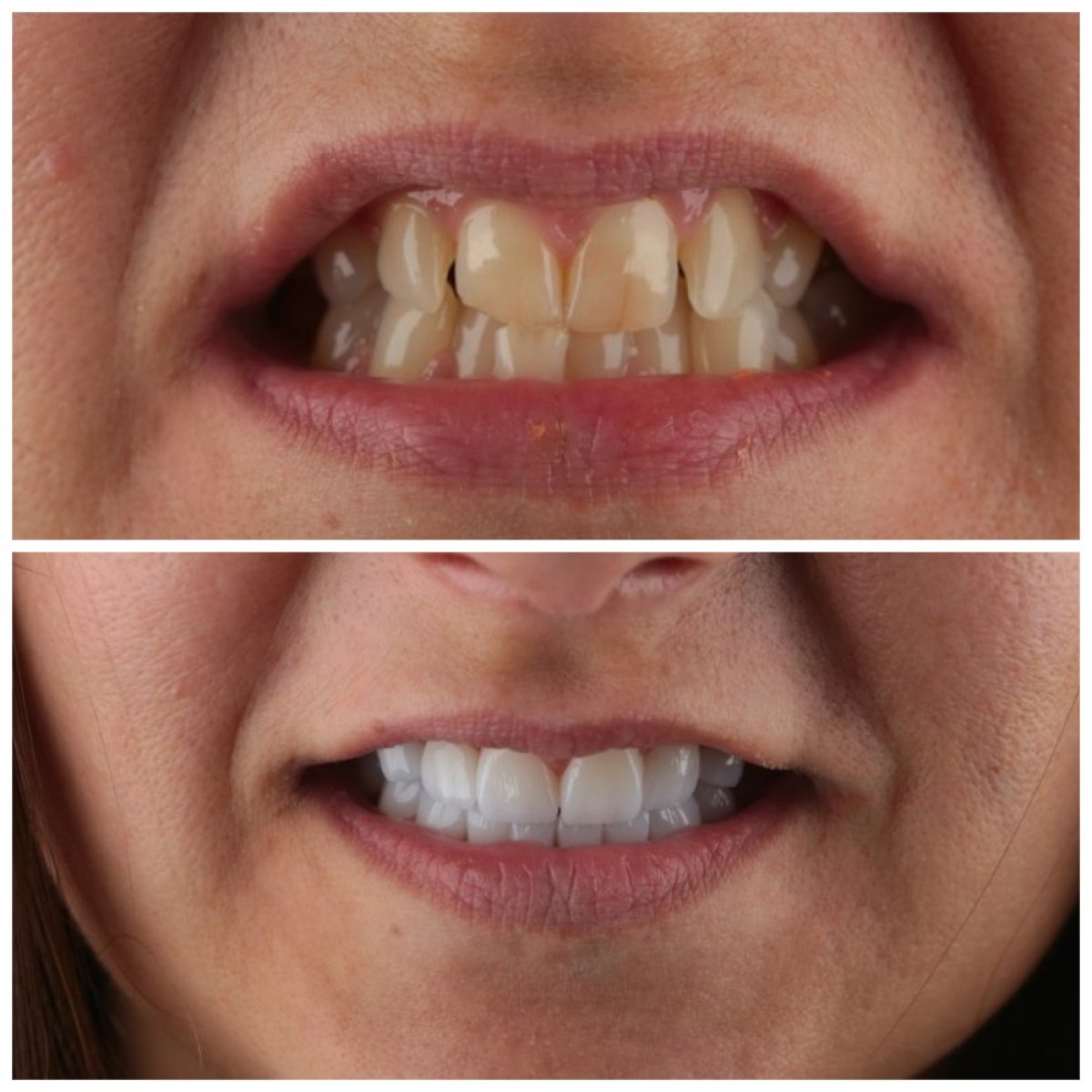 До и после установки виниров в SUAVE DENTAL CLINIC, преображение улыбки с естественным результатом