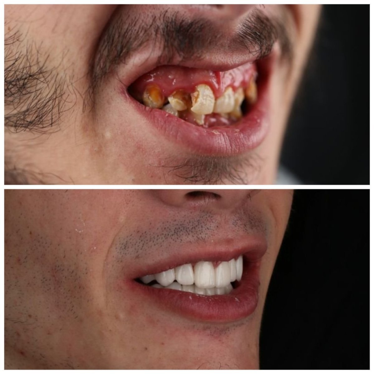 До та після встановлення вініров у SUAVE DENTAL CLINIC, перетворення посмішки з природним результатом