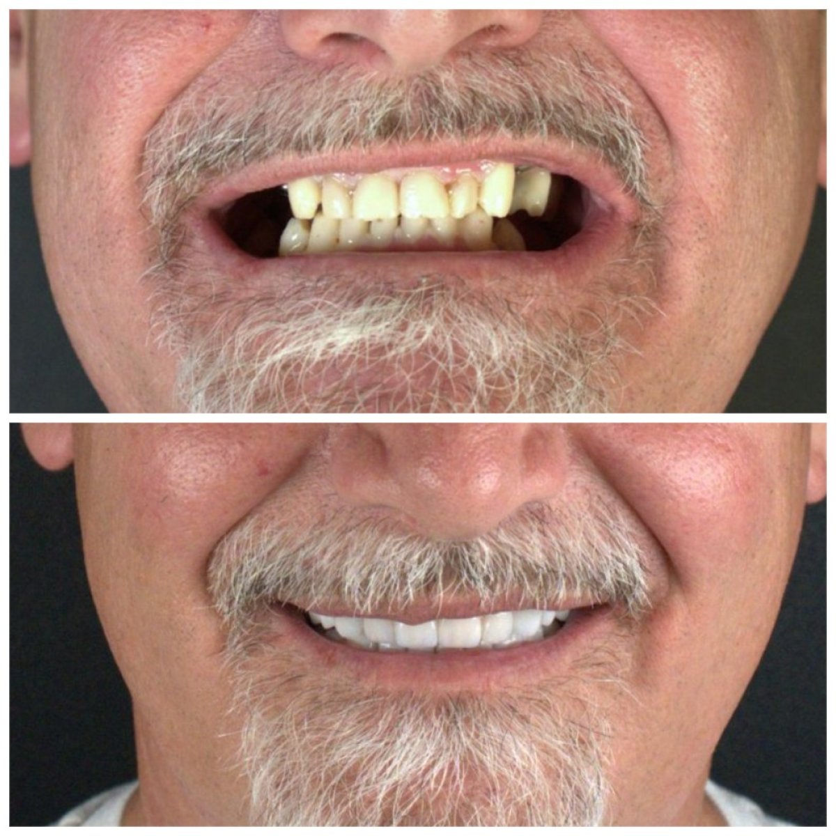 До и после установки виниров в SUAVE DENTAL CLINIC – естественное преображение улыбки