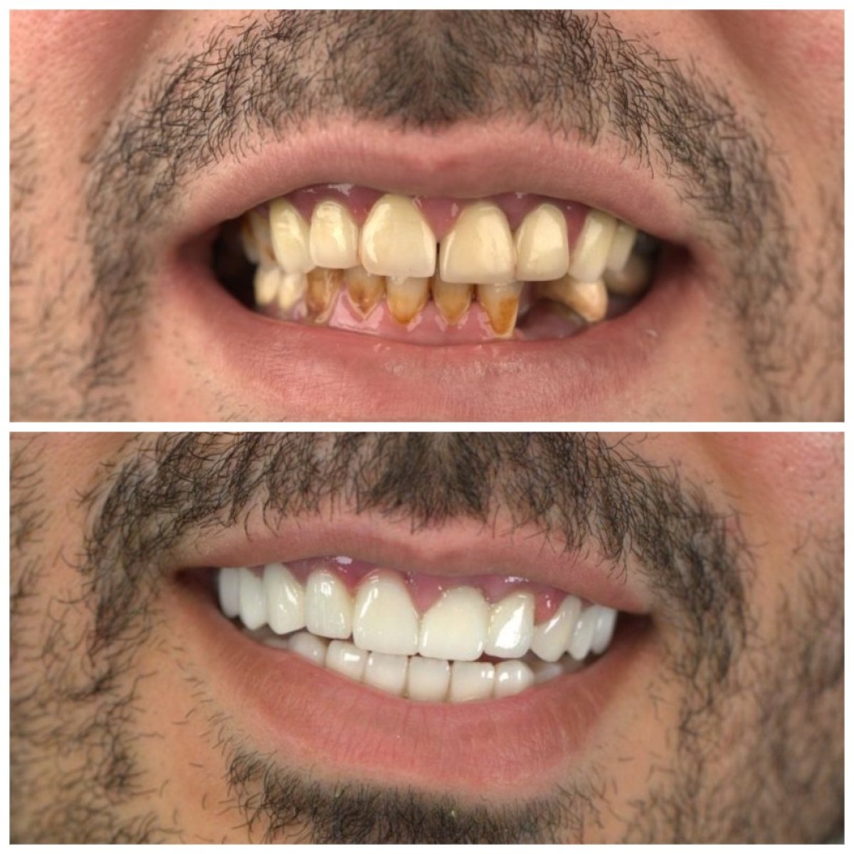 До и после установки виниров в SUAVE DENTAL CLINIC, преображение улыбки с натуральным результатом
