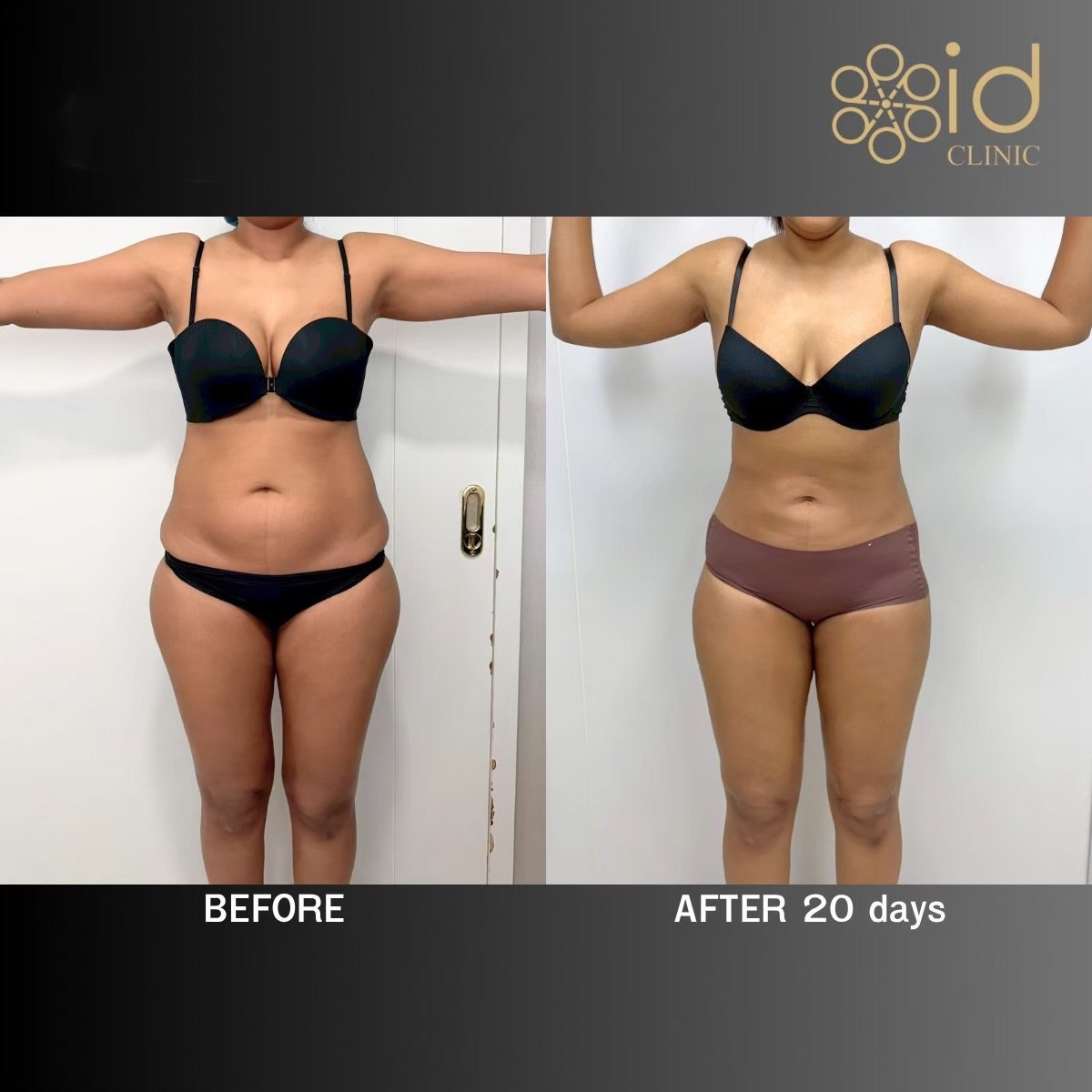 Before and after BodyTite body contouring results at ID Clinic Bangkok, visible slimming effect