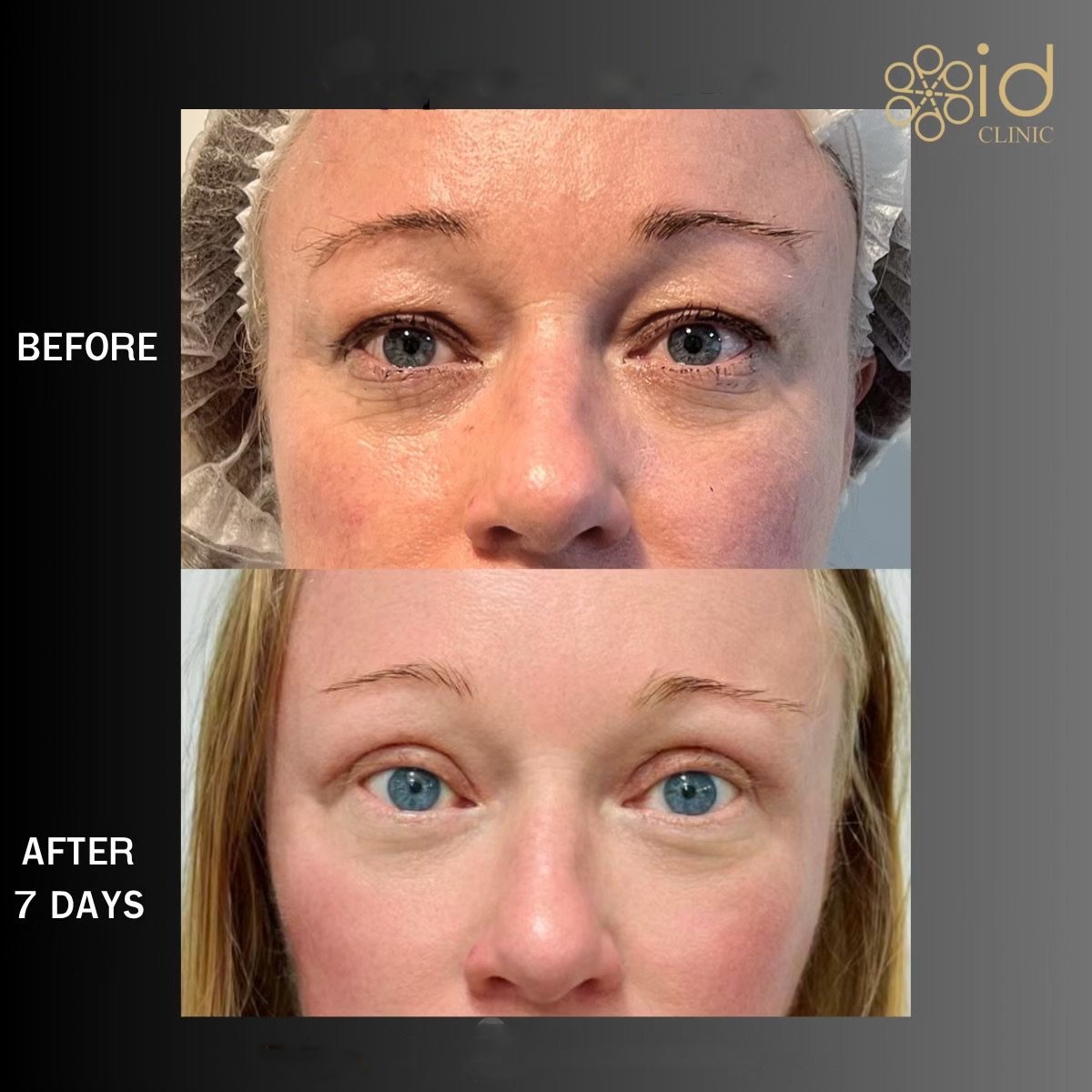Before and after blepharoplasty results at ID Clinic Bangkok, eyelid correction after 7 days