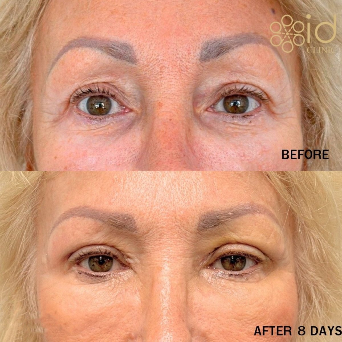 Before and after blepharoplasty results at ID Clinic Bangkok, eyelid correction after 8 days