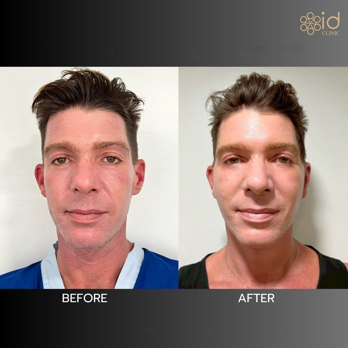 نتائج شد الوجه قبل وبعد في ID Clinic Bangkok، تجديد واضح لملامح الوجه